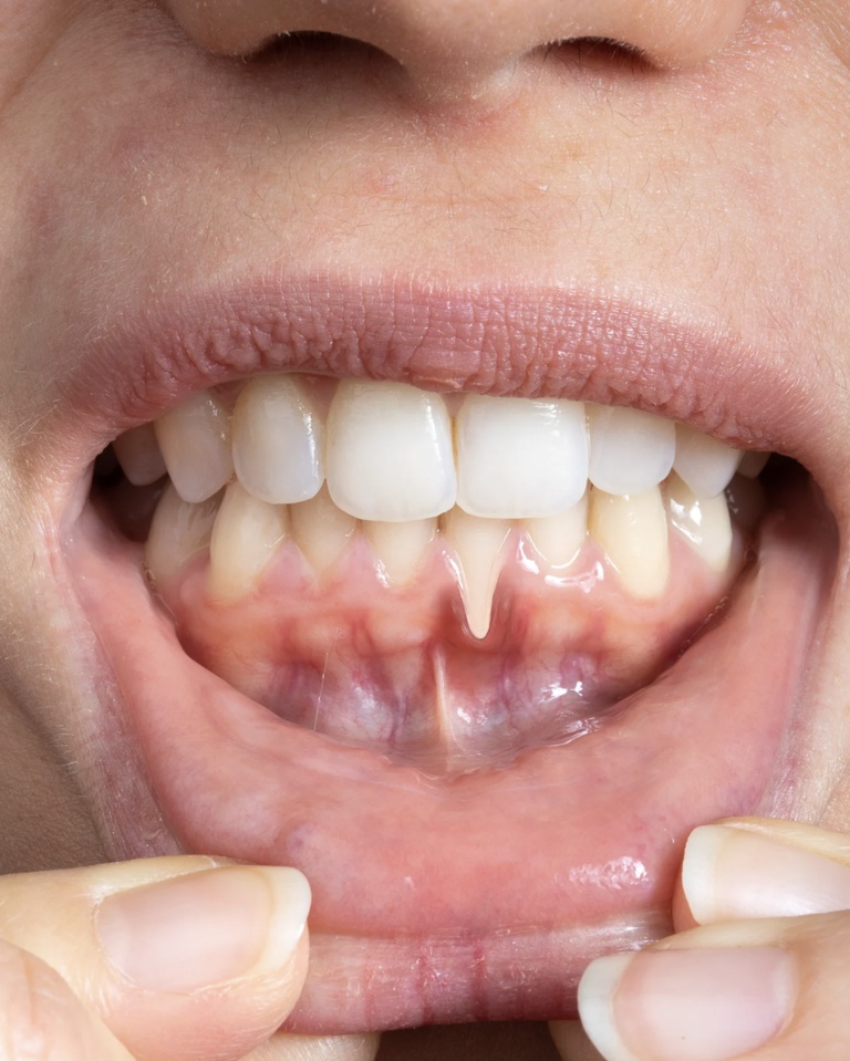 Récession gingivale 